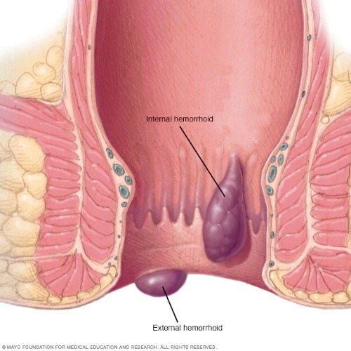 Best Piles treatment in Hyderabad | Piles Surgeon -Dr. N.S. Babu