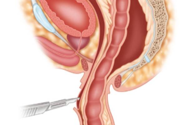 Best Rectal Prolapse Treatment - Dr. N. Subrahmaneswara Babu