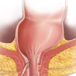 What Happens if Fistula is Not Treated on Time