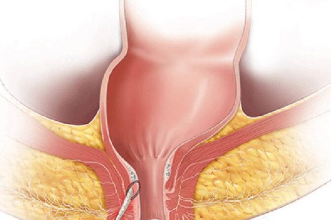 What Happens if Fistula is Not Treated on Time