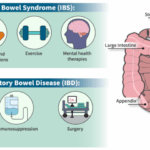 Illustration depicting the differences between IBD and IBS symptoms and treatments.