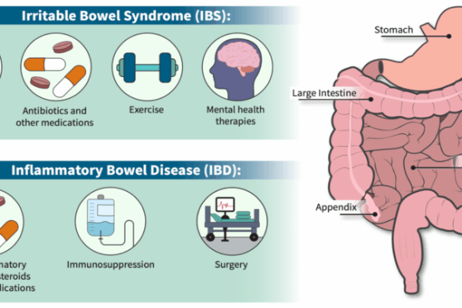 Illustration depicting the differences between IBD and IBS symptoms and treatments.