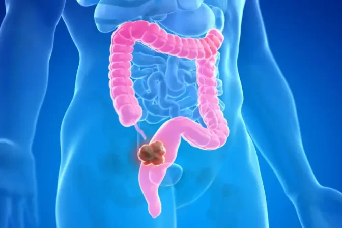 Dr. N. S. Babu – colorectal surgeon Secunderabad specializing in piles, fistula, fissure & minimally invasive colorectal surgery