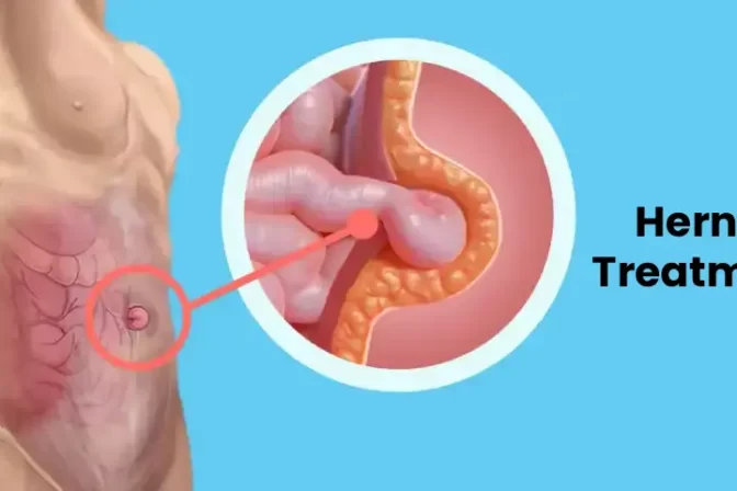 Hernia treatment options consultation by hernia specialist in Hyderabad, Dr. N Subrahmaneswara Babu, Hills Gastro & Onco Care