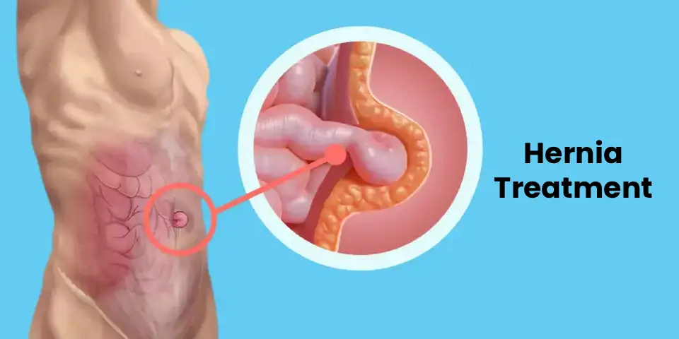 Hernia treatment options consultation by hernia specialist in Hyderabad, Dr. N Subrahmaneswara Babu, Hills Gastro & Onco Care
