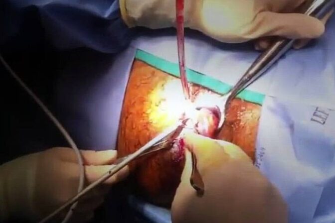 Dr. N. Subrahmaneswara Babu explaining laser vs traditional hemorrhoid surgery options