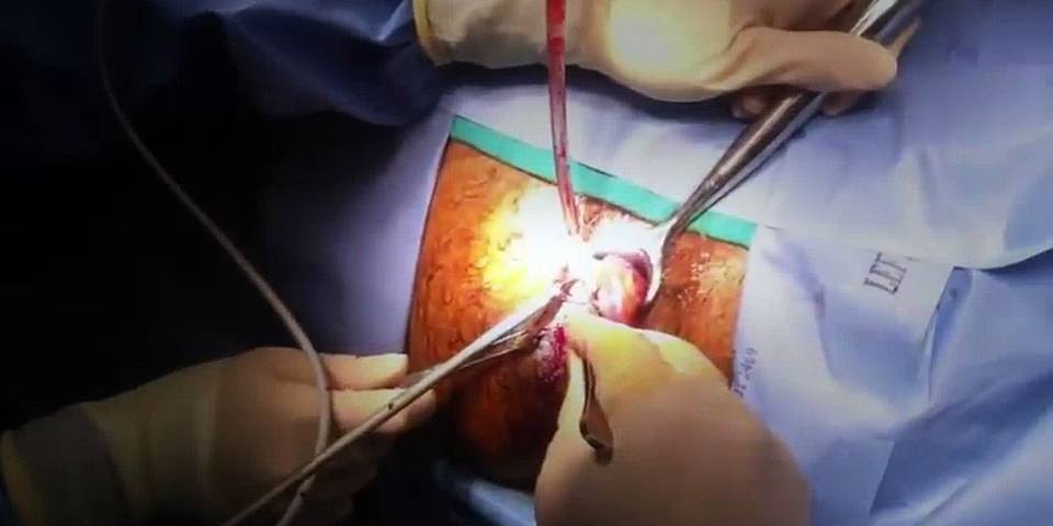 Dr. N. Subrahmaneswara Babu explaining laser vs traditional hemorrhoid surgery options