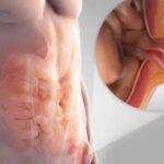 Can you prevent a hernia – expert advice from the best hernia specialists in Hyderabad