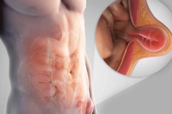 Can you prevent a hernia – expert advice from the best hernia specialists in Hyderabad