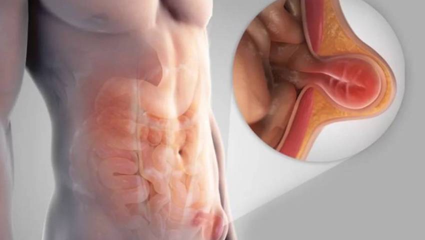 Can you prevent a hernia – expert advice from the best hernia specialists in Hyderabad
