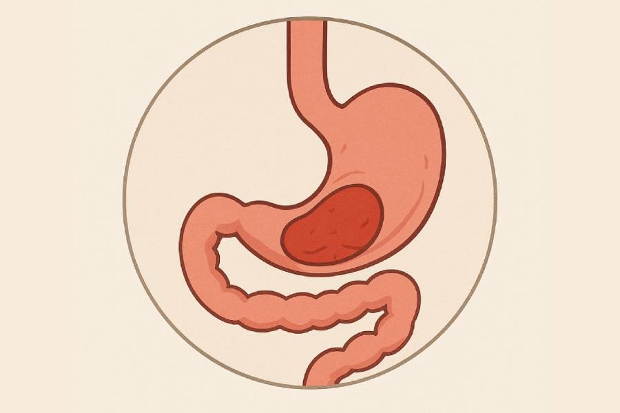 Advanced Hiatus Hernia Treatment in Hyderabad | Best Hiatus Hernia Specialist – Dr. N. S. Babu Advanced Hiatus Hernia Treatment in Hyderabad by Dr. N. Subrahmaneswara Babu