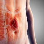 Is hernia curable without surgery – expert explanation by Dr. N. Subrahmaneswara Babu at Hills Gastro & Onco Care Hyderabad