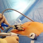 Laparoscopic hernia surgery vs open surgery comparison explained by hernia specialist in Hyderabad