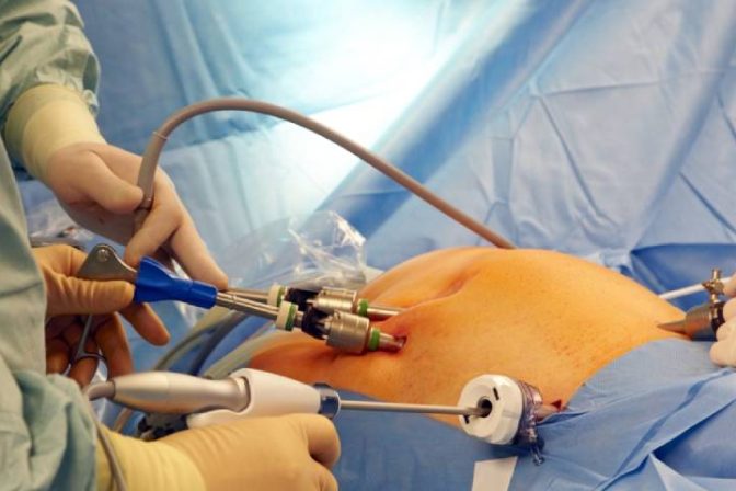 Laparoscopic hernia surgery vs open surgery comparison explained by hernia specialist in Hyderabad