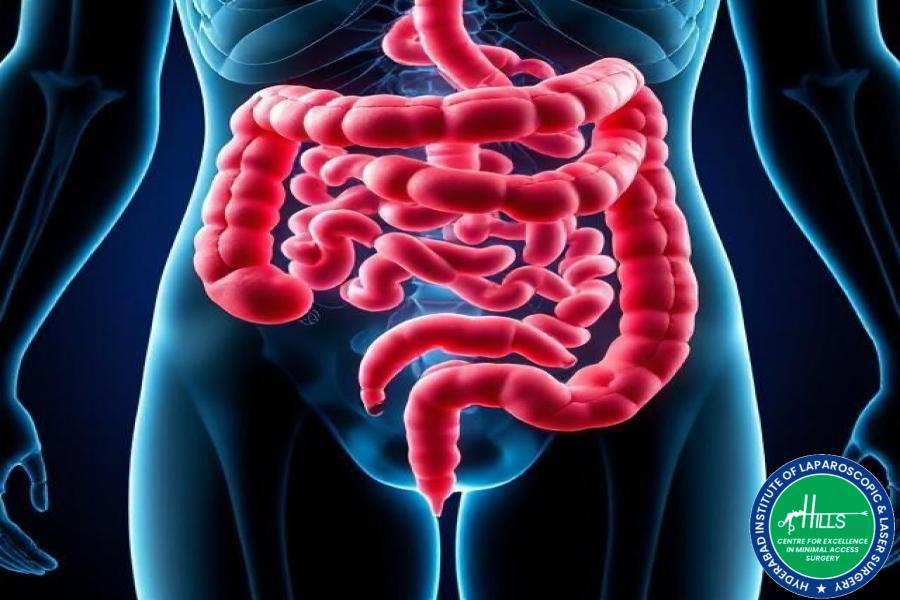 Irritable Bowel Syndrome Treatment In Hyderabad for IBS symptoms, bloating, constipation, and diarrhea